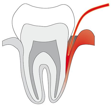 Parodontitis / © Cumdente Bild Parodontitis / © Cumdente