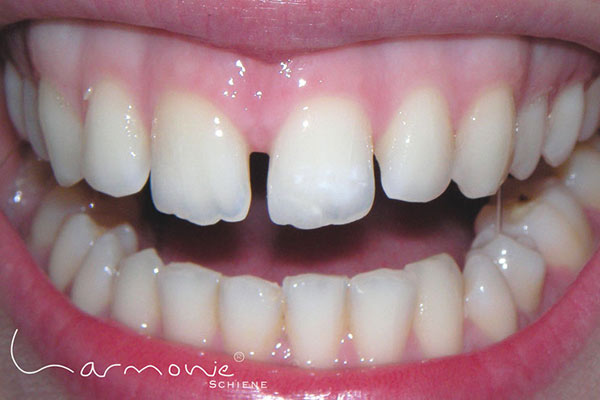 Zahnlücke / © Orthos Bild Zahnlücke / © Orthos